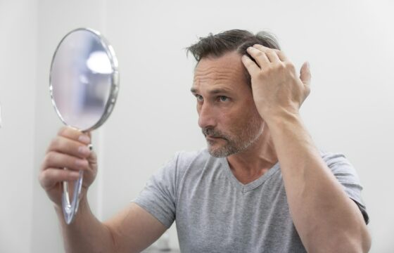 Receding Hairline? Here’s What You Can Do